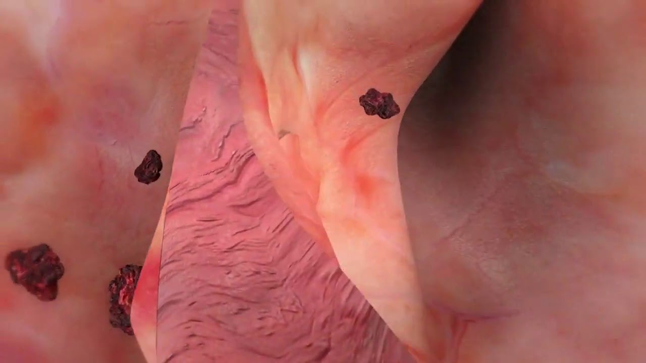 Patent Foramen Ovale Closure   Amplatzer PFO Occluder