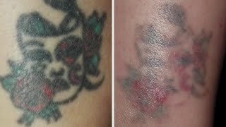 Get rid of unwanted tattoos or spots with laser surgery from Grand Pearl Spa