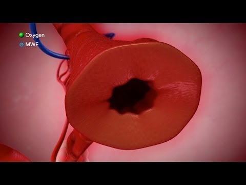 Video: Alveolitis (pljuča) - Vzroki, Simptomi, Zapleti In Zdravljenje Alveolitisa