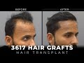 Turning back time the amazing results of hair transplantation at cara