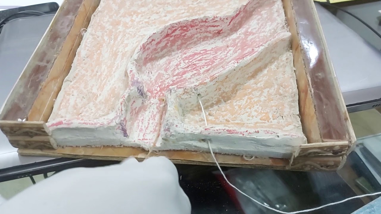 How to change kshar sutra in fistula demo by Dr.Abhishek Sharma