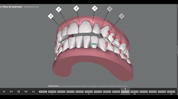 Transforming Smiles: ClinCheck simulation to Correct Open Bite and Crossbite with Invisalign!