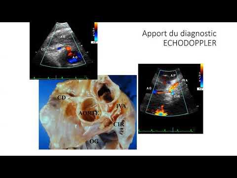 Vidéo: Hémosidérophages sinusaux de la rate chez le chien