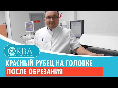 😯 Красный рубец на головке после обрезания. Клинический случай №566
