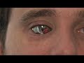 Man sees with bionic eye