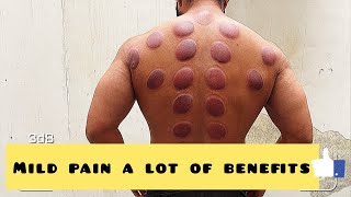 Hijama therapy (wet cupping) done by DK Accupressure karnal