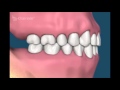 Что будет если не протезировать удаленные зубы на верхней челюсти  Потеря зубов