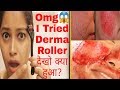 I tried Derma Roller|चहरे के गड्ढे, दाग धब्बे, पिमपल के निशान, छाइया हमेशा के लिए हटाएBeNatural