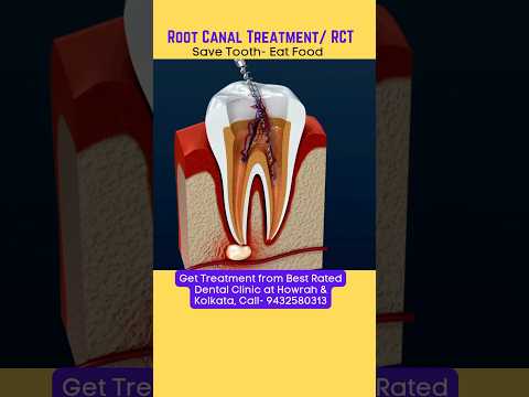 Root Canal Treatment