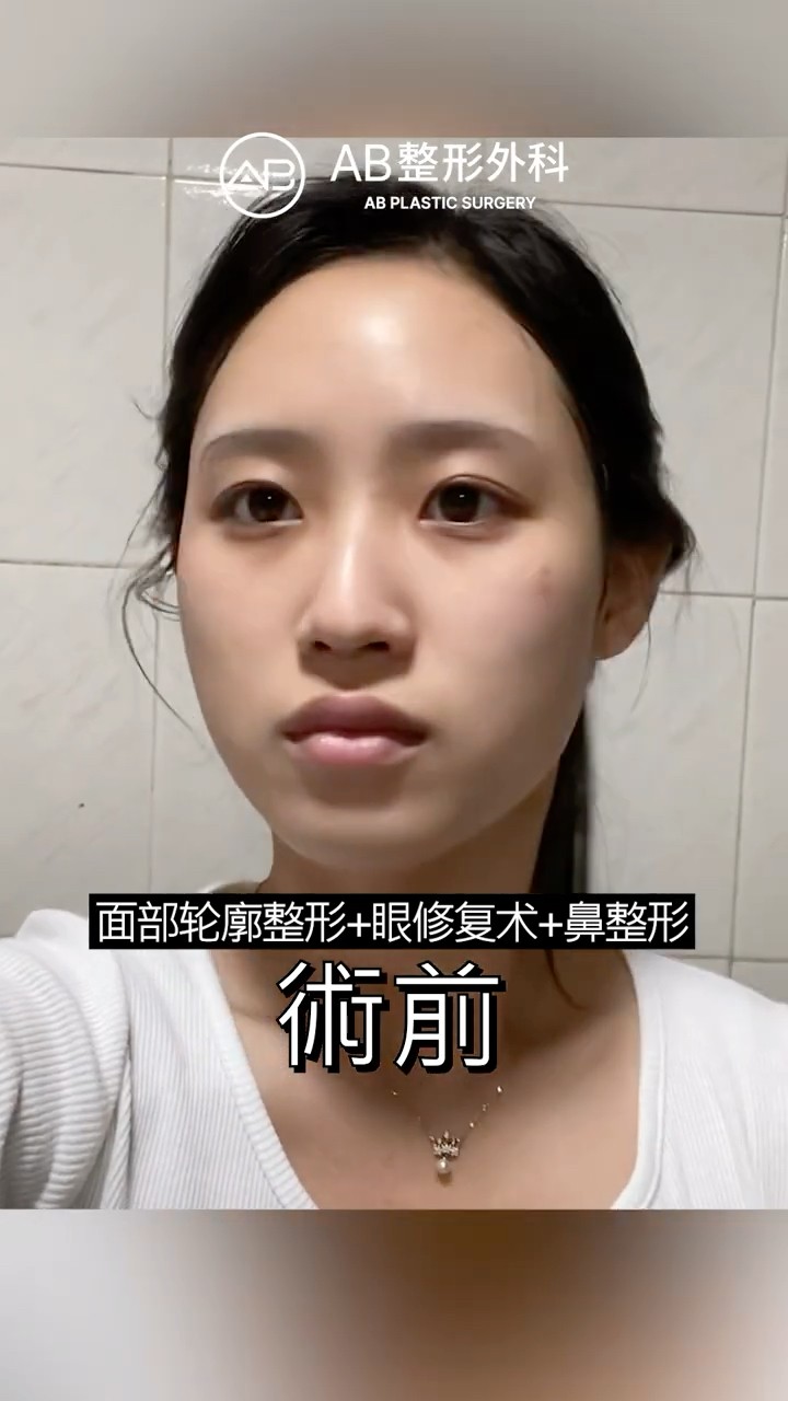 削骨手術5年後｜沒有副作用，還是很美 #shorts