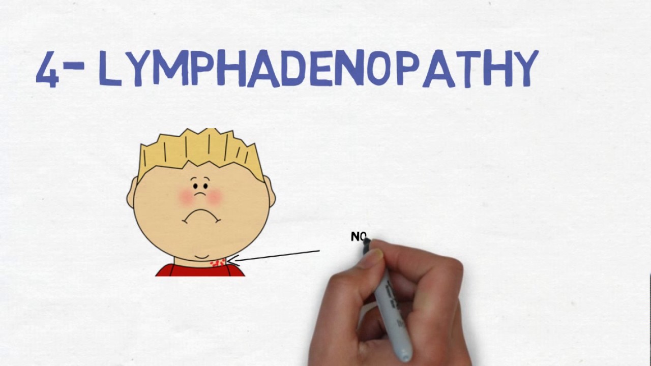 Kawasaki Disease Diagnosis, Treatment And Mnemonic YouTube