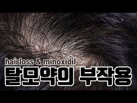 탈모약 <strong>미녹시딜</strong> <strong>부작용</strong> 걱정없이 고르고 사용하는 방법