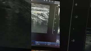 appendicitis