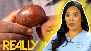 Ginormous Tumour Removed From This Man’s Finger | Dr Pimple Popper: This Is Zit