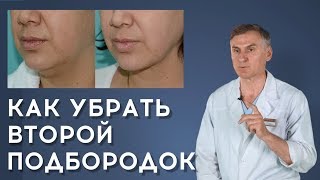 КАК УБРАТЬ ВТОРОЙ ПОДБОРОДОК ❗️БЕЗОПЕРАЦИОННЫЕ МЕТОДЫ И ПЛАСТИКА