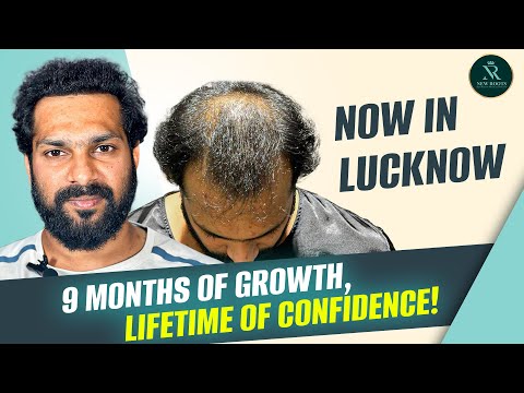 This 9-Month Hair Transplant Result Will Surprise You 😱 | Lucknow | New Roots