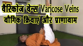 Varicose Vein-वैरिकोज वेन्स में योग व प्राणायाम||Yoga asanas to Treat Varicose Veins | Varicose Vein