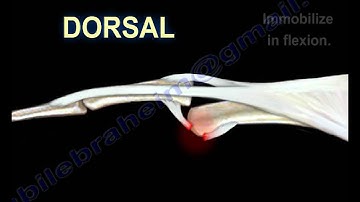 Dislocations Of The Finger - Everything You Need To Know - Dr. Nabil Ebraheim
