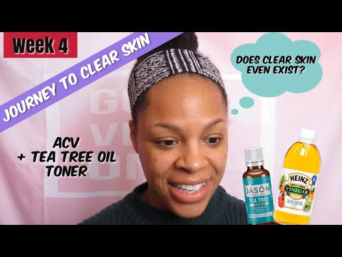 DIY Acne Toner Using Apple Cider Vinegar & Tea Tree Oil //Chit Chat: How Not To Extract A Blackhead!
