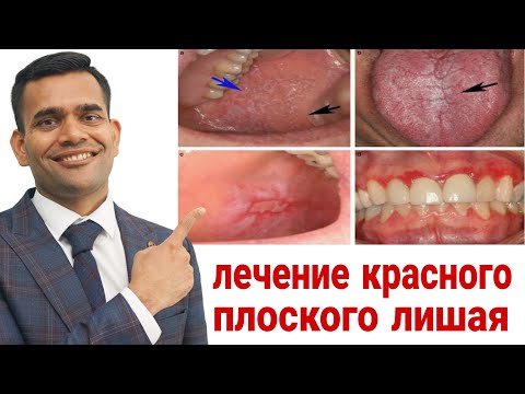 лечение красного плоского лишая - Доктор Вивек