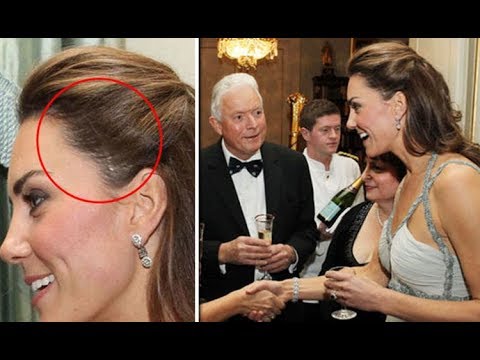 REVEALED: The reason why Kate Middleton has a SCAR on her head - Daily News