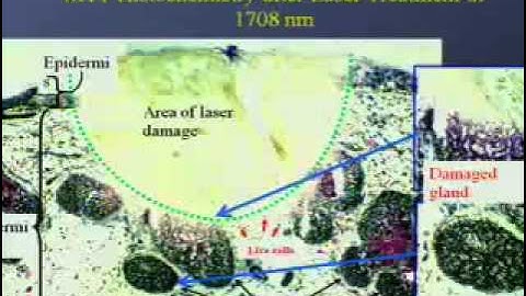 SURE2009:Mid-Infrared Medical Lasers for Dermatology and Cardiovascular Applications