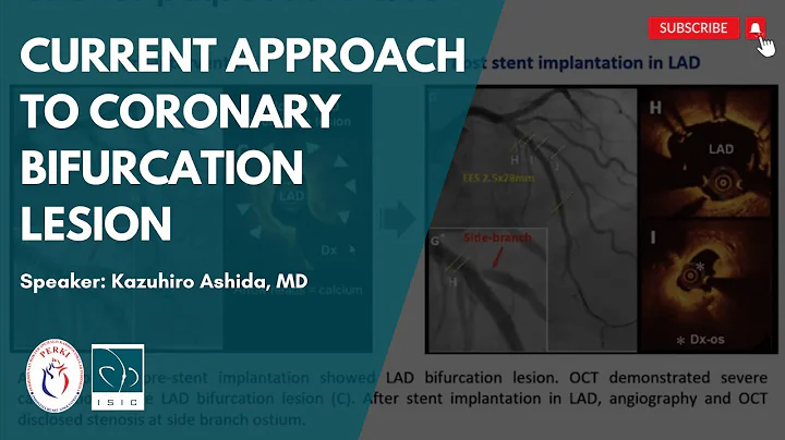 Distance Learning (Jul 4th, 2020) - Current Approach to Coronary Bifurcation Lesion