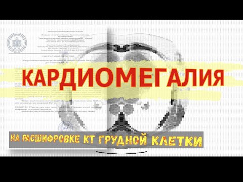 КАРДИОМЕГАЛИЯ на РАСШИФРОВКЕ КТ органов грудной клетки.  Легочная гипертензия.