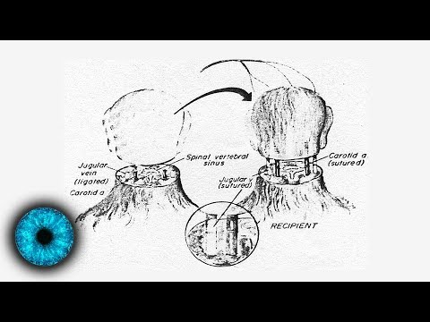 Unvorstellbar: Kopf soll auf neuen Körper transplantiert werden - Clixoom Science & Fiction