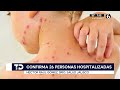 Hay 26 personas hospitalizadas por sarampión en Jalisco