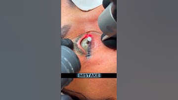 👀One Mistake Could Blind You! 😱#shorts #eyes #laser #hairremoval