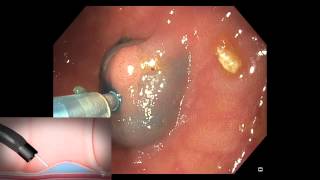 Serrated Polyps of the Colon Part 3