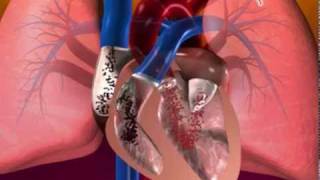 MyHEALTH : Penyakit Jantung Kongenital