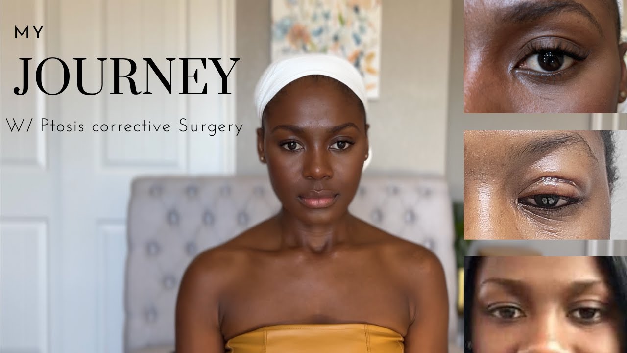 Ptosis surgery experience (photos Included) YouTube