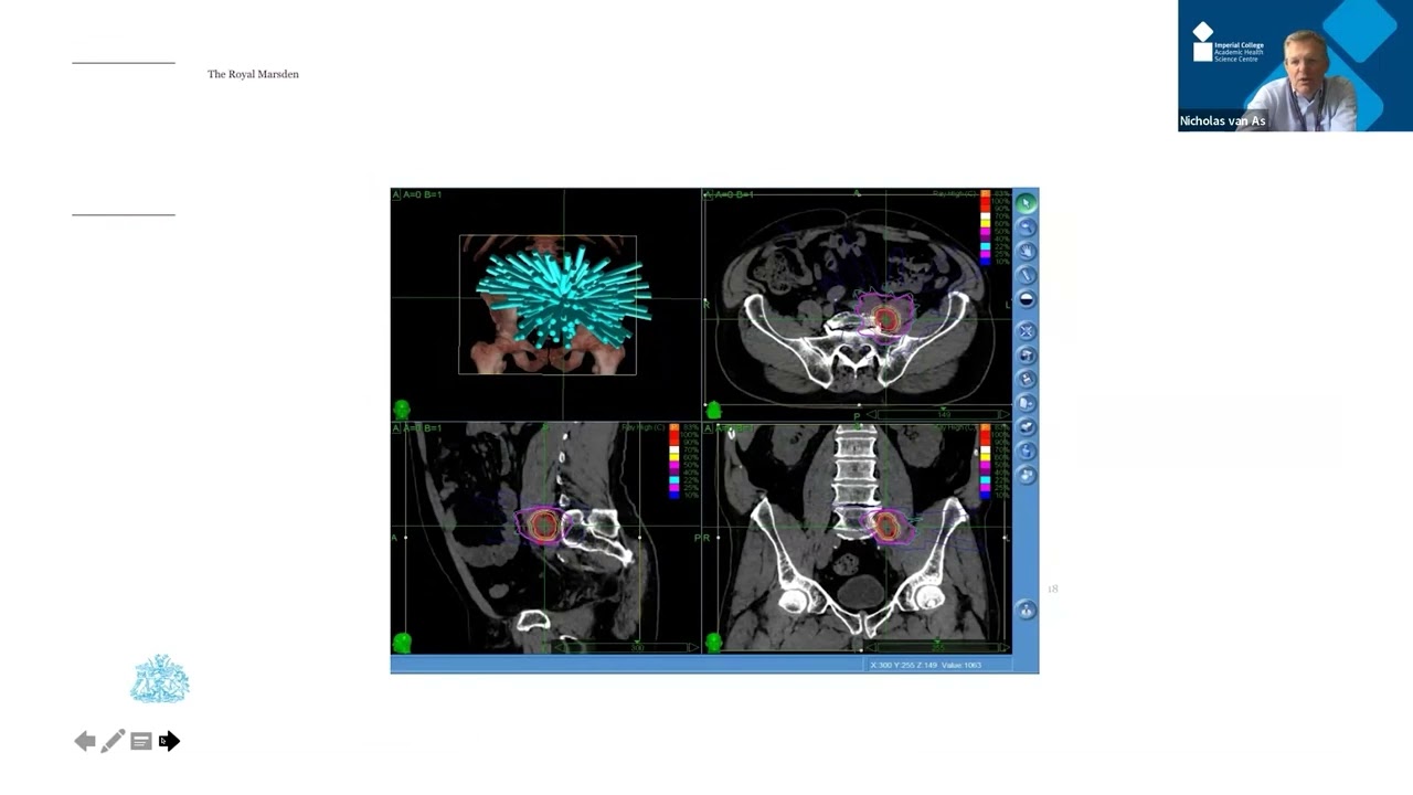 Understanding radiation exposure & improving patient outcomes from radiotherapy (2/2) Nick van As