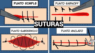 PUNTOS DE SUTURA QUIRURGICA |SIMPLE, SARNOFF, SUBDERMICO Y ANCLADO #sutura