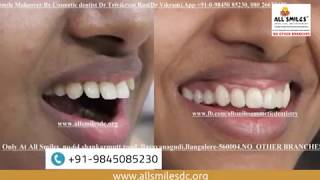 Smile Makeover Before and After | Cosmetic Dentistry in Bangalore, India