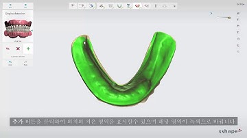 3DBioCAD - 3Shape Implant Studio - 무치아 케이스: 스캔 정렬 및 치은 설정법