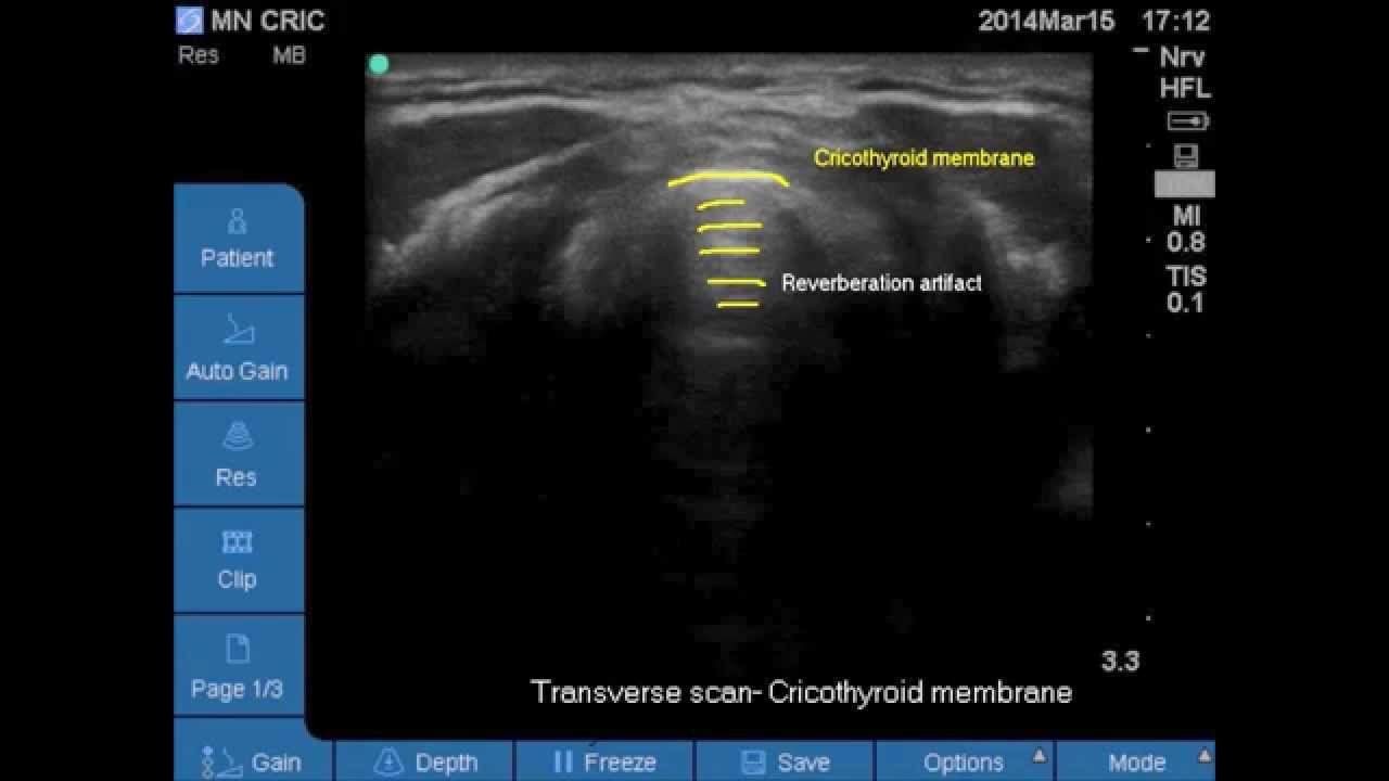 Ultrasound Airway anatomy- Vocal cords, Cricothyroid membrane, Cricoid