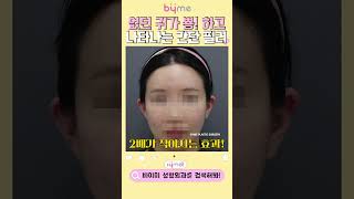 얼굴작아지는 요정 귀필러 전후 feat. 필러장인 성형외과전문의 #shorts