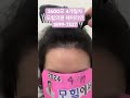 엠자 및 측면 구레나룻 디자인 #구레나룻모발이식 #측면라인교정 #헤어라인교정