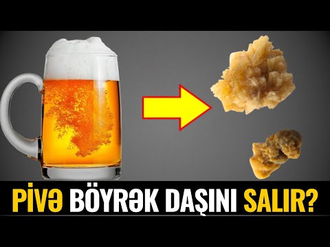 Böyrəyində, SİDİK kanalında DAŞ olanlar! Bu videoya MÜTLƏQ BAXIN!