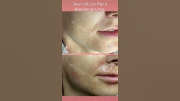 Plasma Pen Jowl Lift, Lip Flip & Nasolabial Lines
