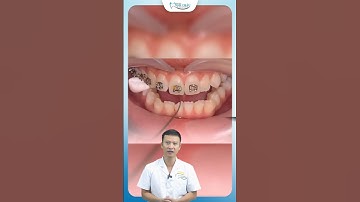 Gắn Mắc Cài Có Đau Không | Nha Khoa Minh Châu