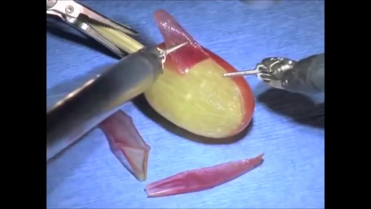 They Performed Surgery On A Grape