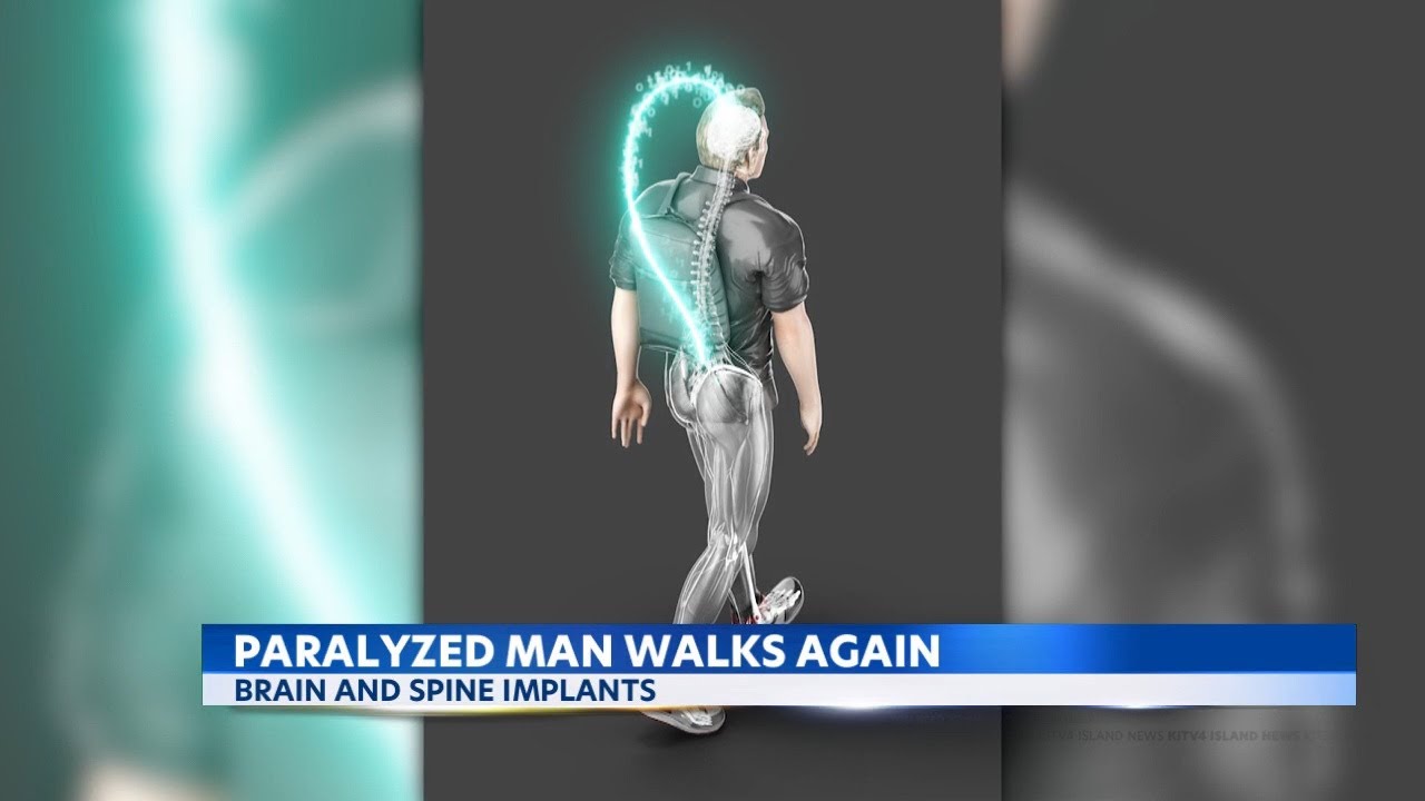 Man with paralysis walks naturally after brain, spine implants