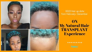 My Afro Hair Transplant Journey from DR DUCU