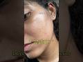 If You Have Comedones Then Add These In Your Routine For Next 3 Months Skinbumps Comedones 