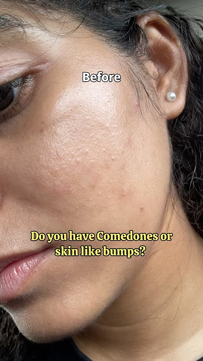If you have comedones then Add these in your routine for next 3 months #skinbumps #comedones