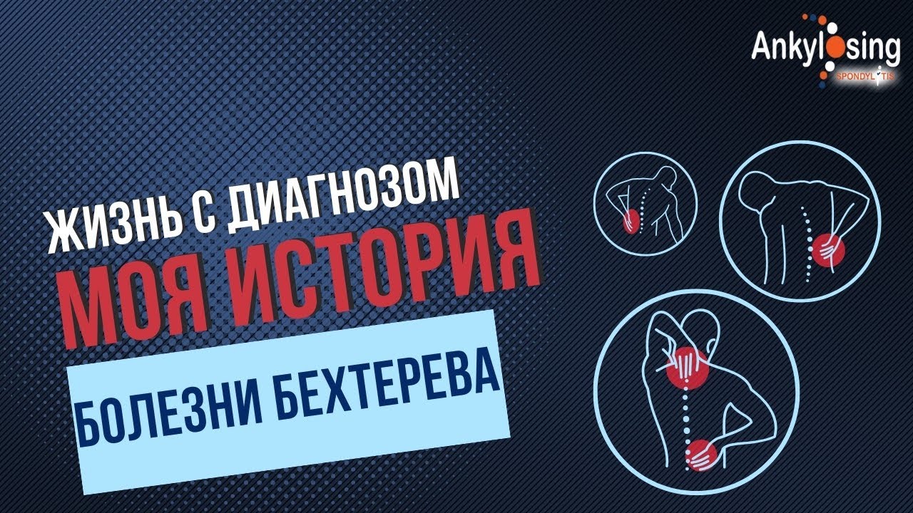 Жизнь с диагнозом болезнь Бехтерева|Моя история — Transcript